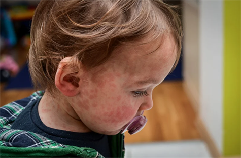 Measles rash on a child.